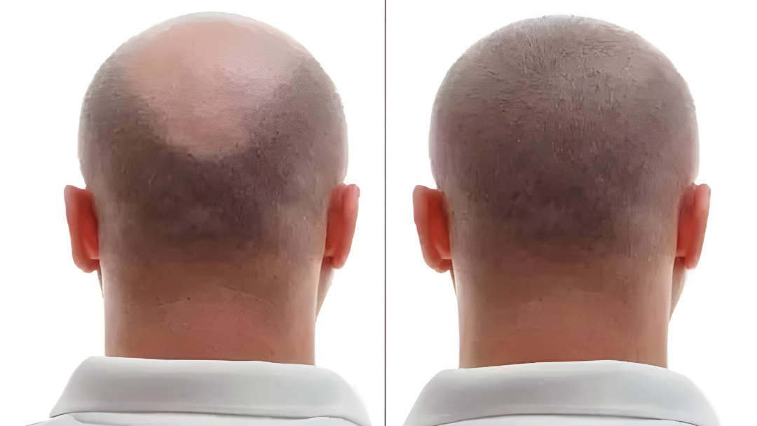 Blijft er een litteken achter na een haartransplantatie?