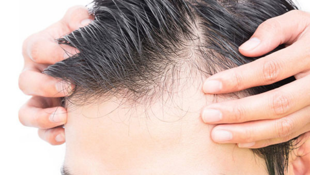 Voor Wie Is Een Haartransplantatie Geschikt?