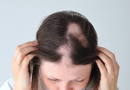 alopecia areata